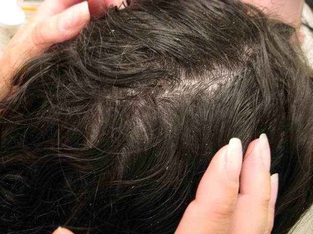 How to Get Rid of Head Lice: Wet Combing, Treatments and Nits
